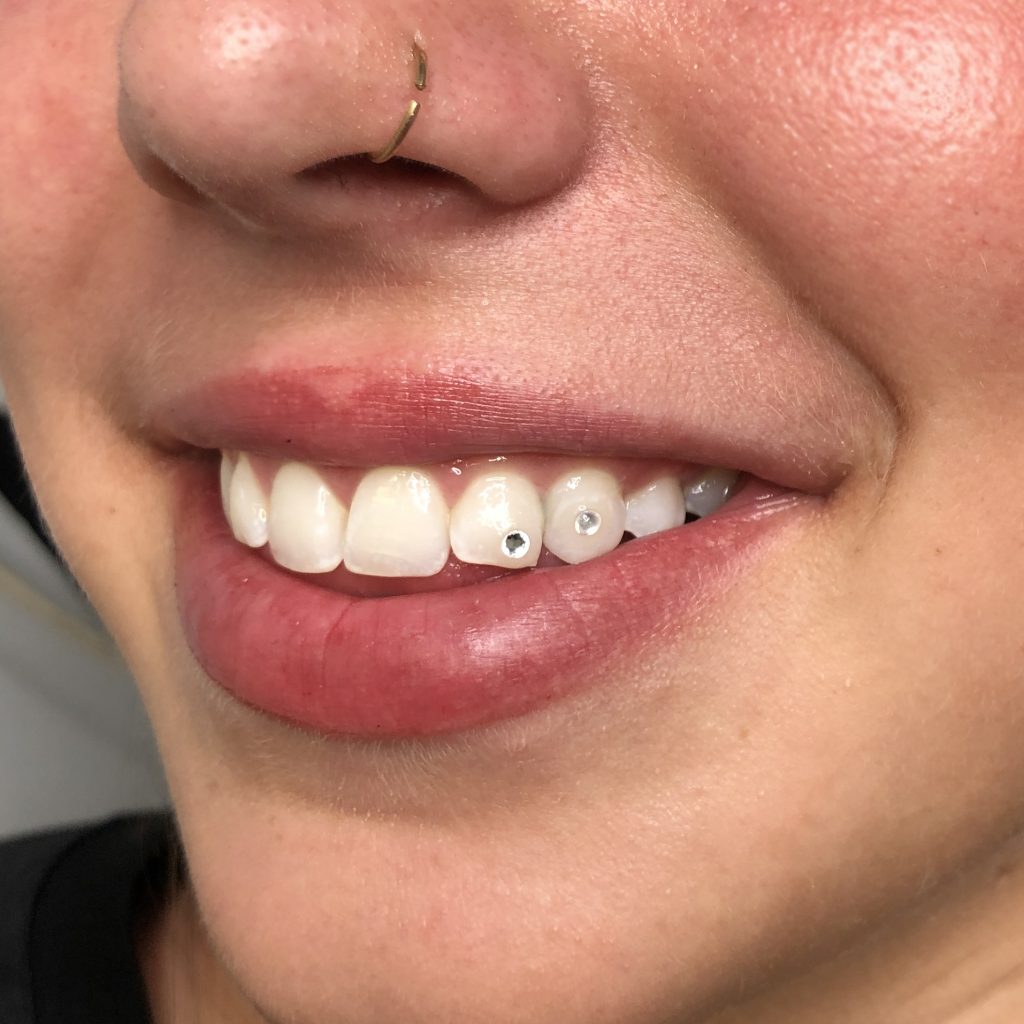Tooth gems in London