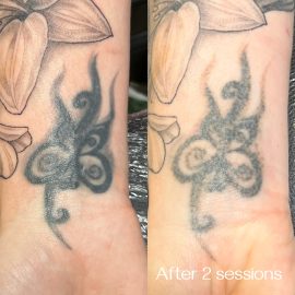 Before and after tattoo removal