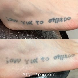 Before and after 2 sessions of tattoo removal on foot