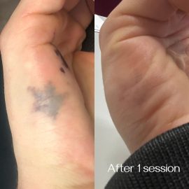 Before and after tattoo removal on hand