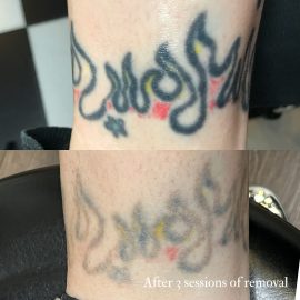 Tattoo removal done in London