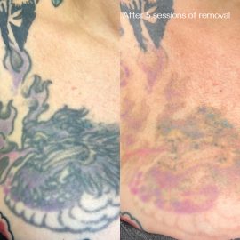 Laser tattoo removal done at Tiger & Rose Tattoo, Seven Sisters, Tottenham, London