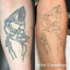 Before and after tattoo removal
