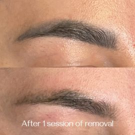 Blue eyebrow tattoo removal done by Dana Depta Permanent Makeup, London