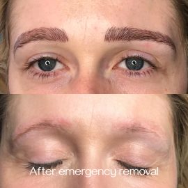 Emergency microblading removal done by Dana Depta Permanent Makeup, London