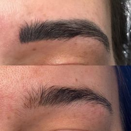 Eyebrow tattoo removal done by Dana Depta Permanent Makeup, London