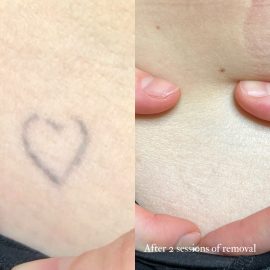 Tattoo removal before and after
