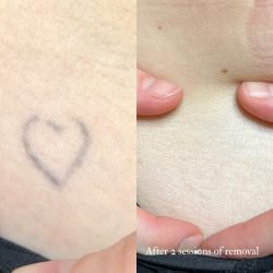 created by photogrid Heart tattoo removal