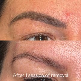 Laser eyebrow tattoo removal done by Dana Depta Permanent Makeup, London