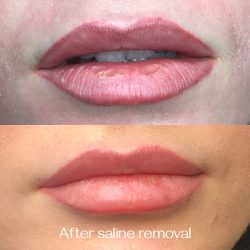 Lip blush removal done by Dana Depta Permanent Makeup, London