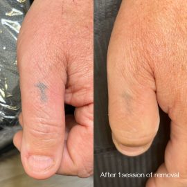 Tattoo removal on thumb