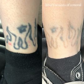 Before and after flame tattoo on ankle