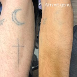 Tattoo removal done in Seven Sisters, London