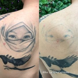 Laser tattoo removal done by Dana Depta Permanent Makeup, London