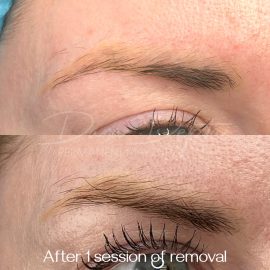 Yellow eyebrow tattoo removal done by Dana Depta Permanent Makeup, London