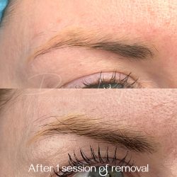 created by photogrid Yellow eyebrow tattoo removal done by Dana Depta Permanent Makeup, London