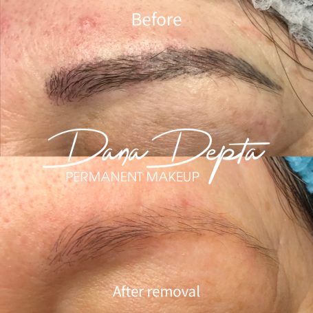 Microblading removal, London