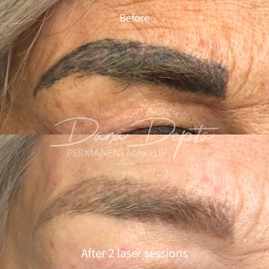 Microblading removal, done at Tiger and Rose Tattoo, London