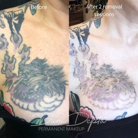 Tattoo removal done at Tiger and Rose Tattoo, London