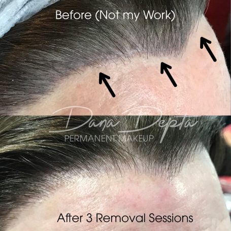 Hairline tattoo removal done at Tiger and Rose Tattoo, London