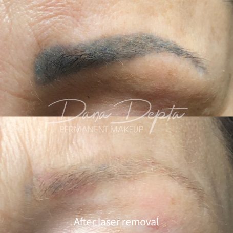 Microblading removal, London