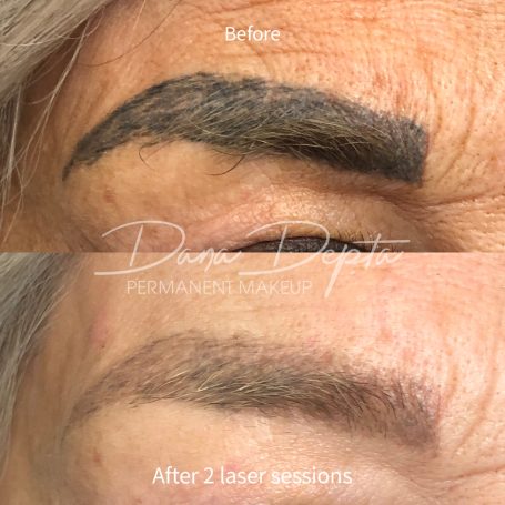 Microblading removal, London