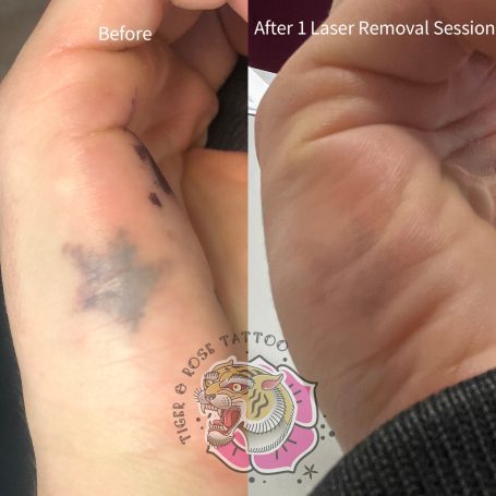 Tattoo removal done at Tiger and Rose Tattoo, London