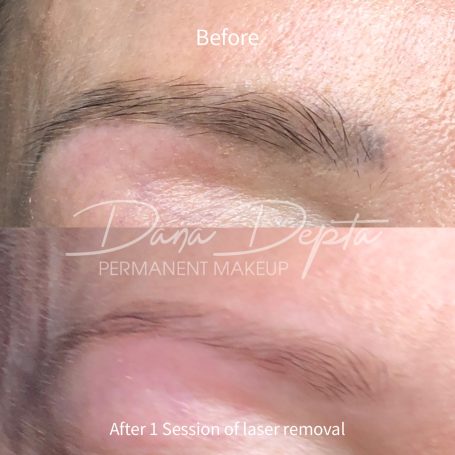 Microblading removal, London