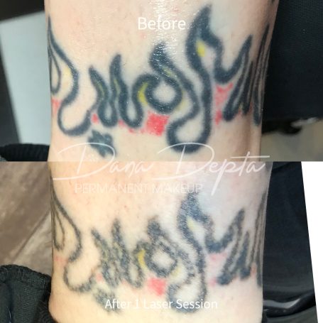 Tattoo removal done at Tiger and Rose Tattoo, London