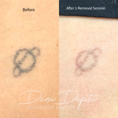 Tattoo removal done at Tiger and Rose Tattoo, London