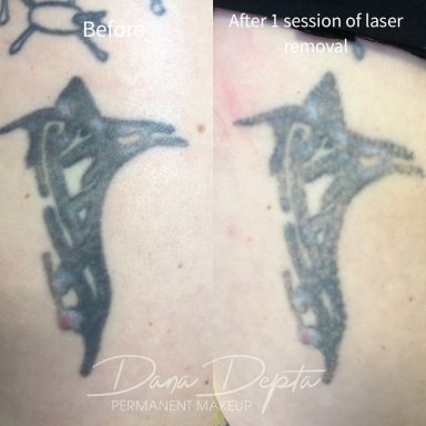 Tattoo removal done at Tiger and Rose Tattoo, London