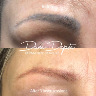 Microblading removal done at Tiger and Rose Tattoo, London