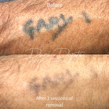 Tattoo removal done at Tiger and Rose Tattoo, London