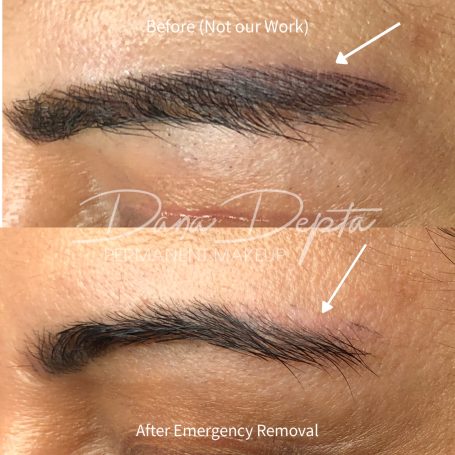 Microblading removal, London