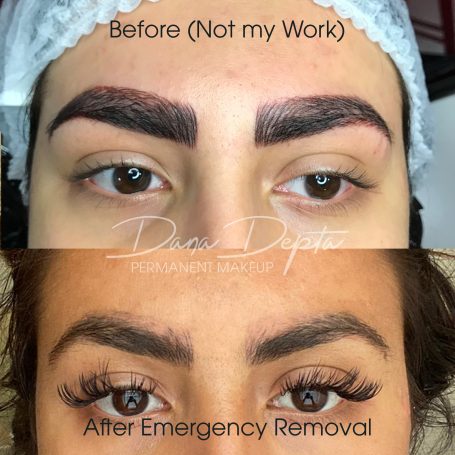 Microblading removal done at Tiger and Rose Tattoo, London