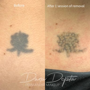 Tattoo removal done at Tiger and Rose Tattoo, London