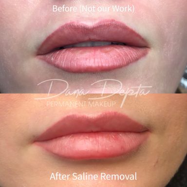 Tattooed lip liner removal done at Dana Depta Permanent Makeup, London