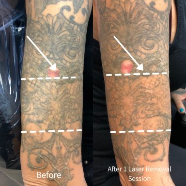 Tattoo sleeve removal done at Tiger and Rose Tattoo, London