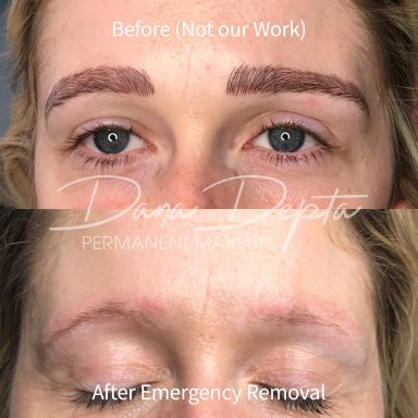 Microblading removal done at Tiger and Rose Tattoo, London