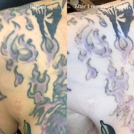 Tattoo removal done at Tiger and Rose Tattoo, London