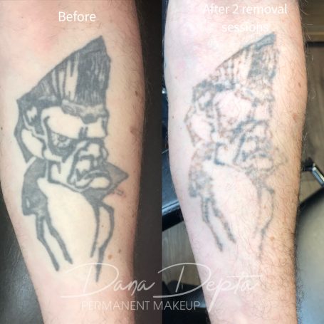 Tattoo removal done at Tiger and Rose Tattoo, London