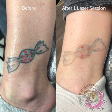 Laser tattoo removal done at Tiger and Rose Tattoo, London