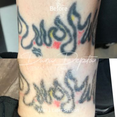 Laser tattoo removal done at Tiger and Rose Tattoo, London