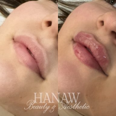 Before and after lip filler London