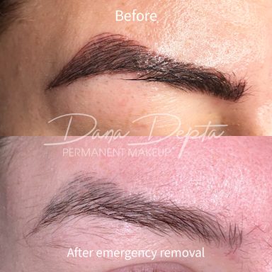 Microblading removal done at Tiger and Rose Tattoo, London