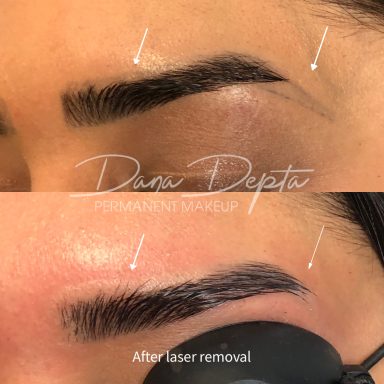 Permanent makeup removal done at Tiger and Rose Tattoo, London