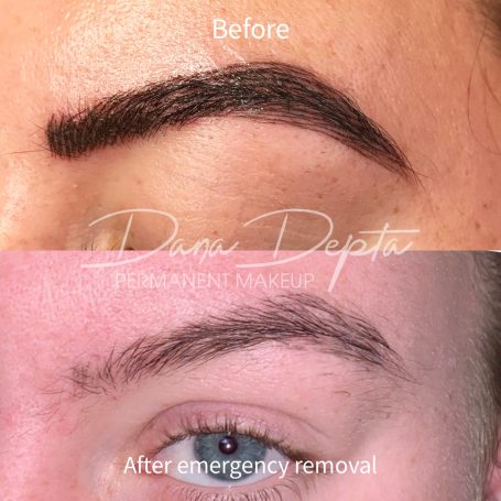 Microblading removal done at Tiger and Rose Tattoo, London