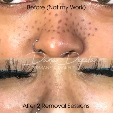 Tattooed freckles removal done at Dana Depta Permanent Makeup, London