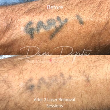 Laser tattoo removal done at Tiger and Rose Tattoo, London