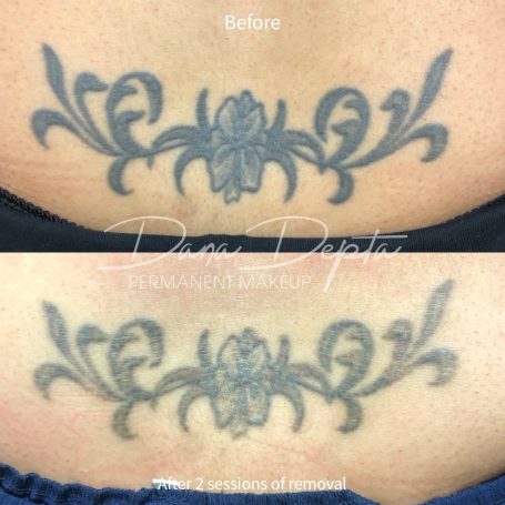 Tattoo removal done at Tiger and Rose Tattoo, London